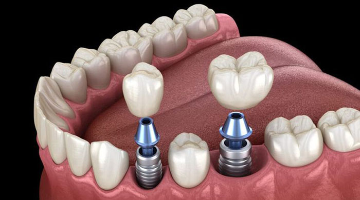 ایمپلنت دندان در اسلامشهر