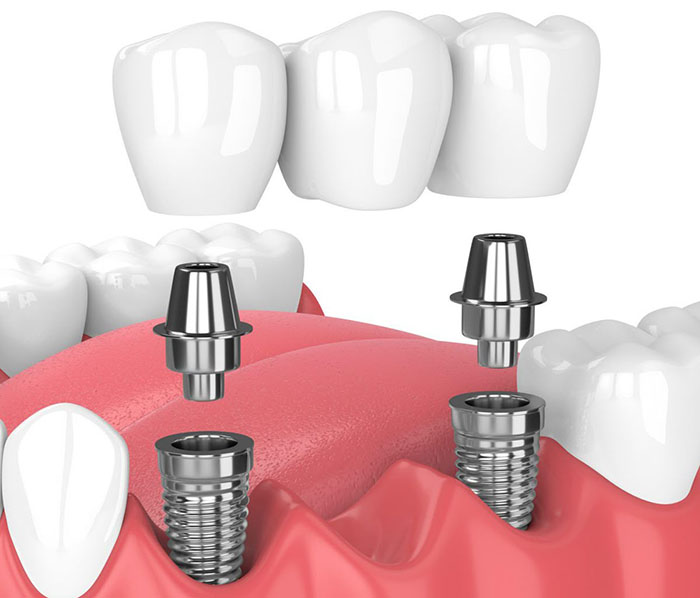 بهترین مرکز ایمپلنت دندان در اسلامشهر
