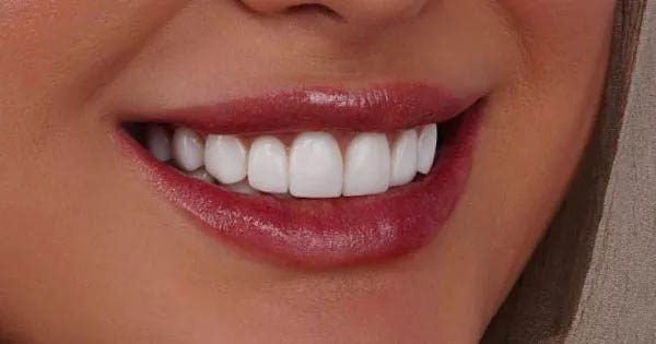 بهترین کلینیک بلیچینگ دندان در اسلامشهر