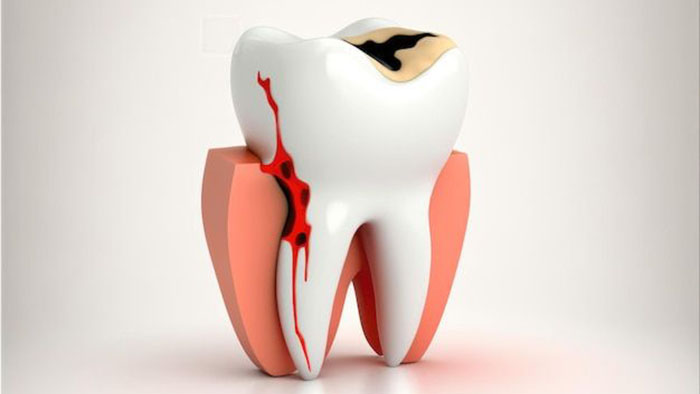 عصب‌کشی دندان در اسلامشهر