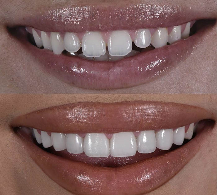 مزایای کامپوزیت دندان در کلینیک رویال مرکزی