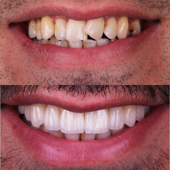 نکات نگهداری بلندمدت لمینت دندان