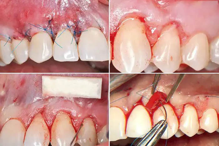 آیا جراحی لثه درد دارد؟
