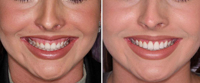 مقایسه جراحی لثه با لیزر لثه